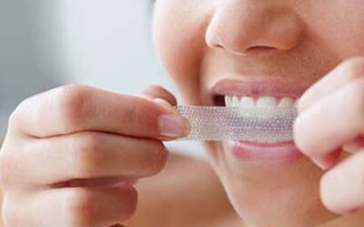 Crest Whitening Strips vs. Professional Teeth Whitening