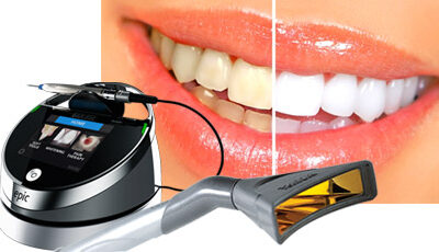 Laser Teeth Whitening Q&A!