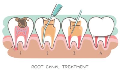 Root Canal Therapy vs. Tooth Extraction: Which is right for me?