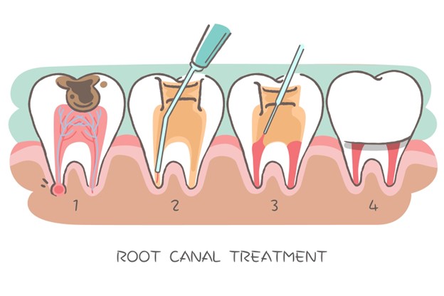 Illustration of the root canal therapy process in Naperville, IL
