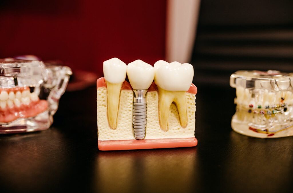 model of dental implants