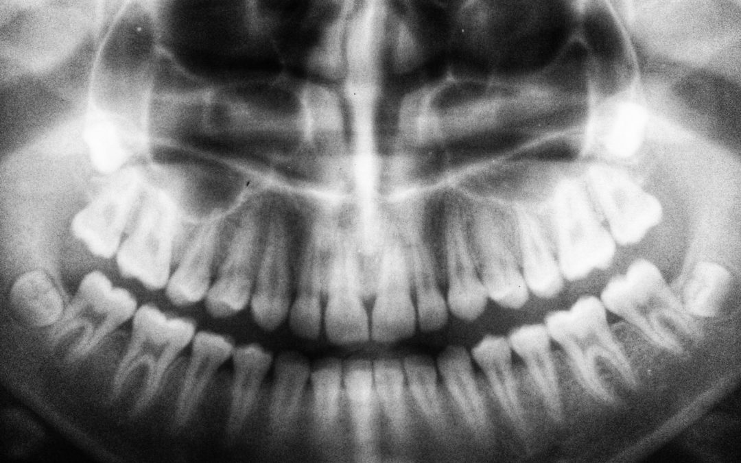 An x-ray image of the teeth and unerupted wisdom teeth