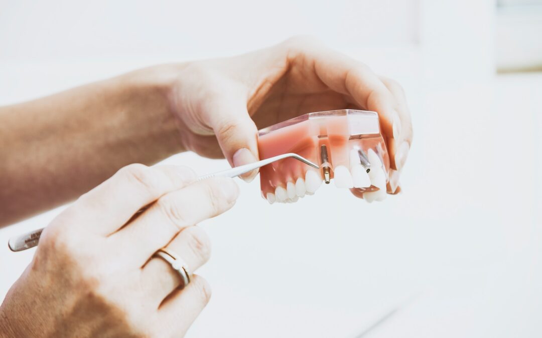 Dentist points to plastic model displaying dental implants