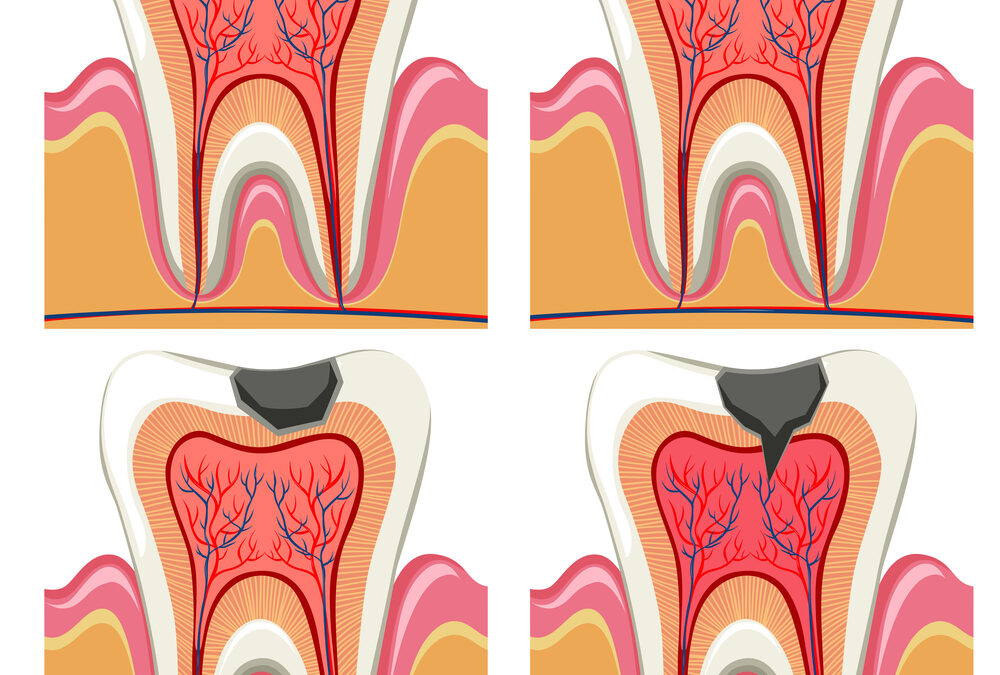 Tooth decay diagram in details illustration