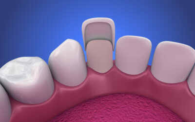Are Porcelain Veneers Worth the Cost?
