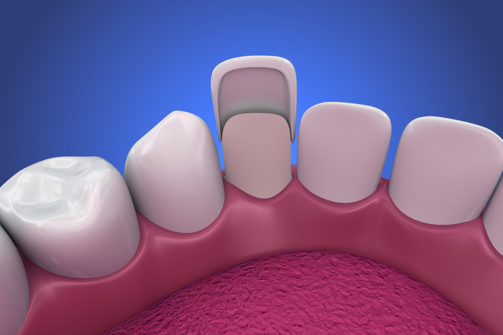 diagram of porcelain veneer placement