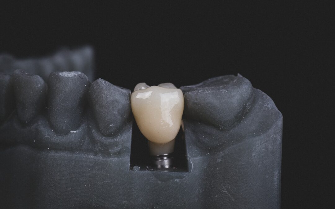 prosthetic lower jaw with teeth and dental implant