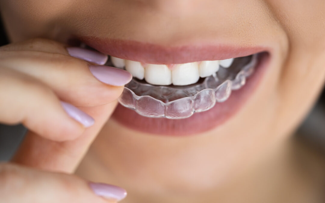 woman putting night guard in her mouth