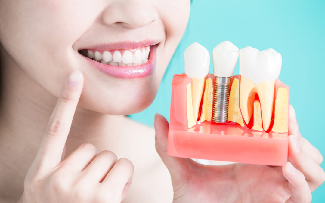 woman holding a dental implant model