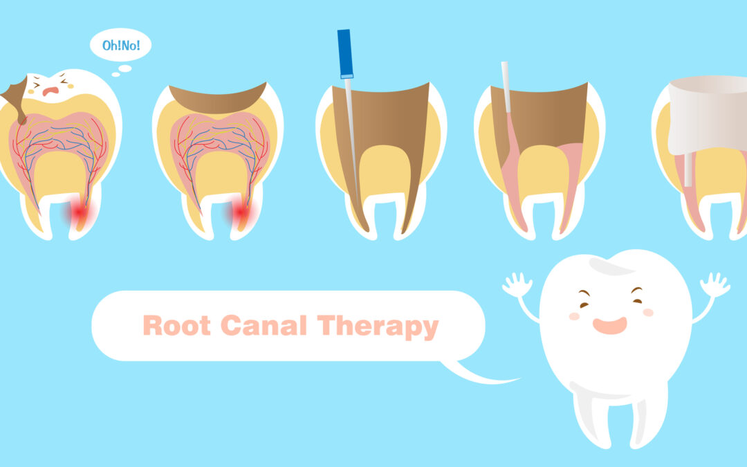 tooth with root canal therapy