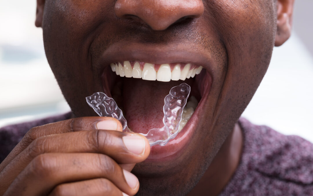 close up of black man placing a dental night guard in his mouth