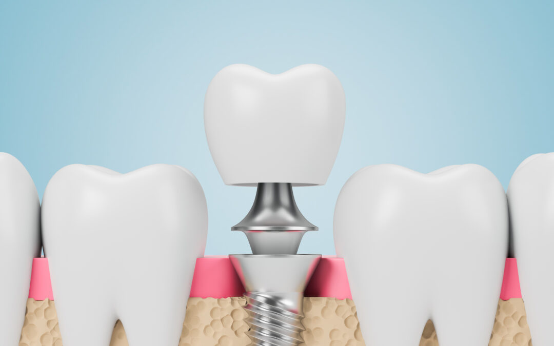 Row of teeth with dental implants over blue background. Concept of dental hygiene and care. 3d rendering