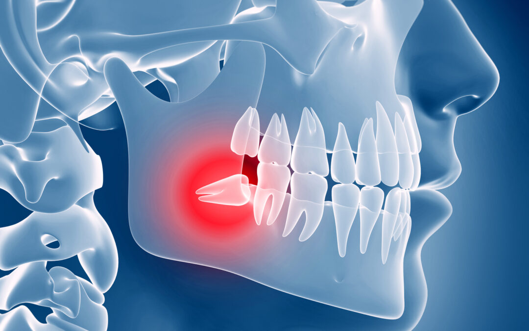 3d rendered illustration of an impacted wisdom tooth