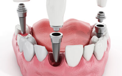 What You Need to Know About Dental Implants