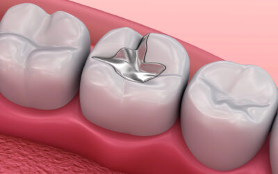 Dealing with Loose or Fallen Dental Fillings: What You Need to Know