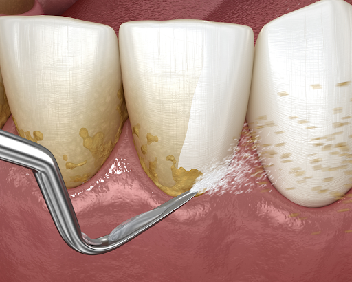 close up of digital teeth and scaler removing plaque