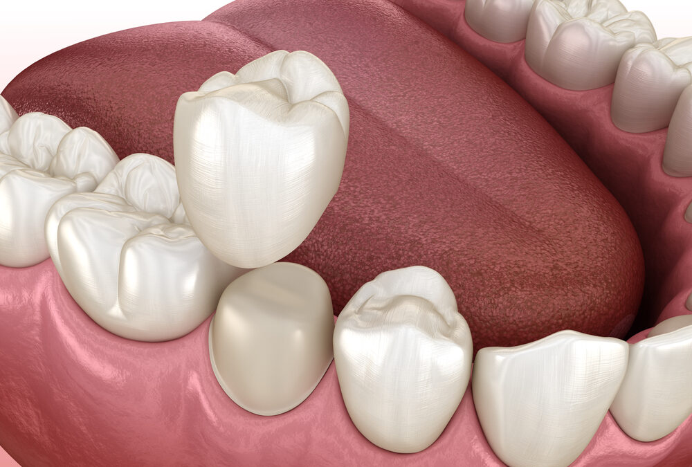 Preparated premolar tooth and dental crown placement. Medically accurate 3D illustration