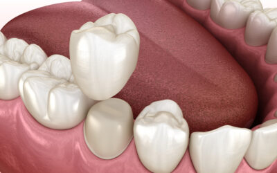 Why You Should Consider Same-Day Crowns in Naperville, IL