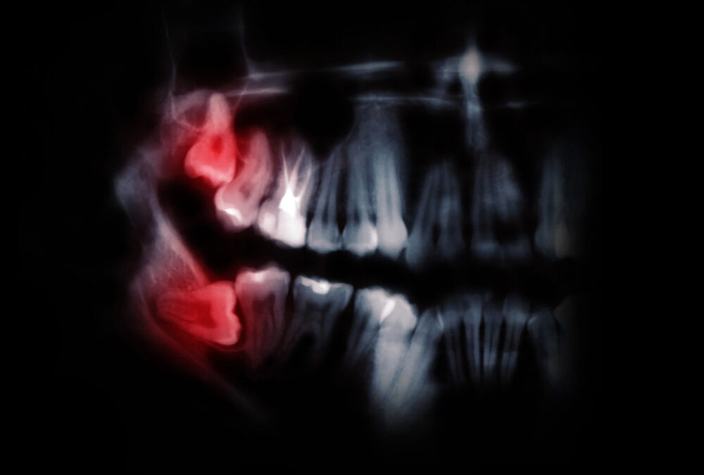 x-ray of top and bottom wisdom teeth pushing against molars