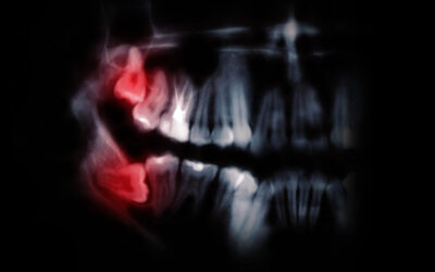 Wisdom Teeth & Health Issues: What You Need to Know