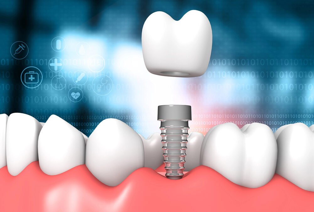 dental implant concept, crown suspended above dental implant placed in lower jaw with blue background