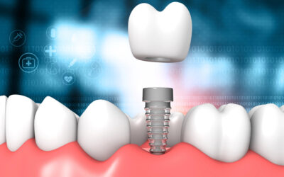 Top 5 Reasons to Choose Dental Implants Naperville Dentists Recommend
