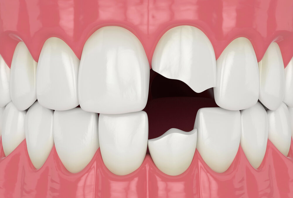 3d render of jaw with broken incisors teeth