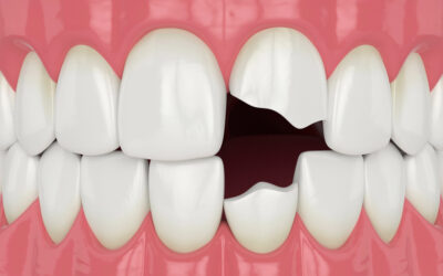 What Are the Most Common Ways to Fix a Chipped Tooth?