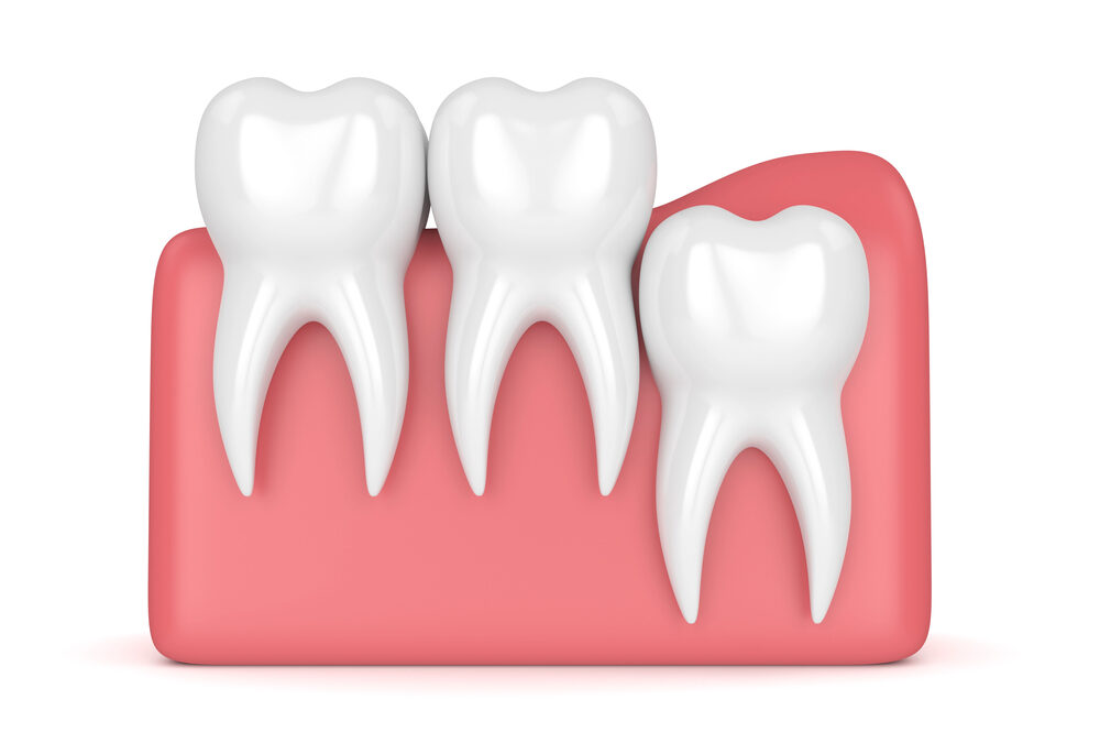 3d render of molars and wisdom teeth