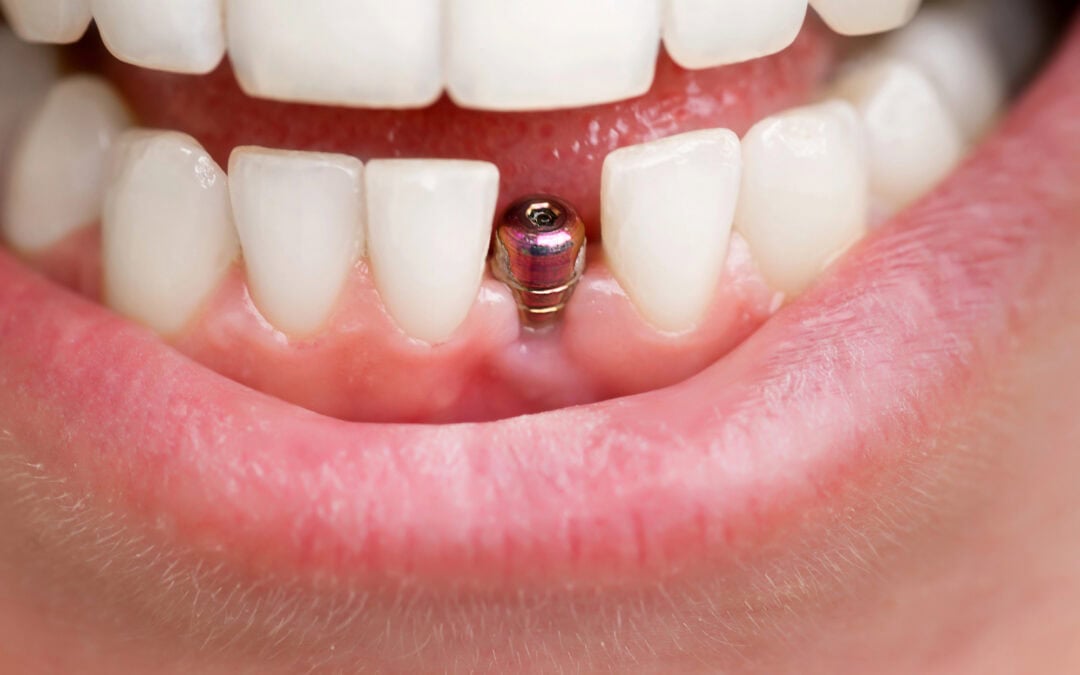 Close up image depicting dental implants in the lower mandible.