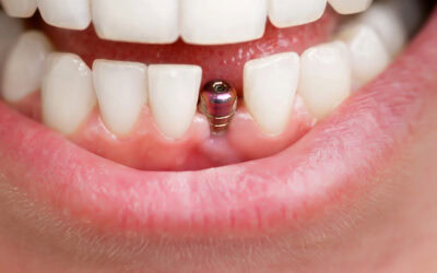 Infection Around Dental Implants: Signs You Shouldn’t Ignore