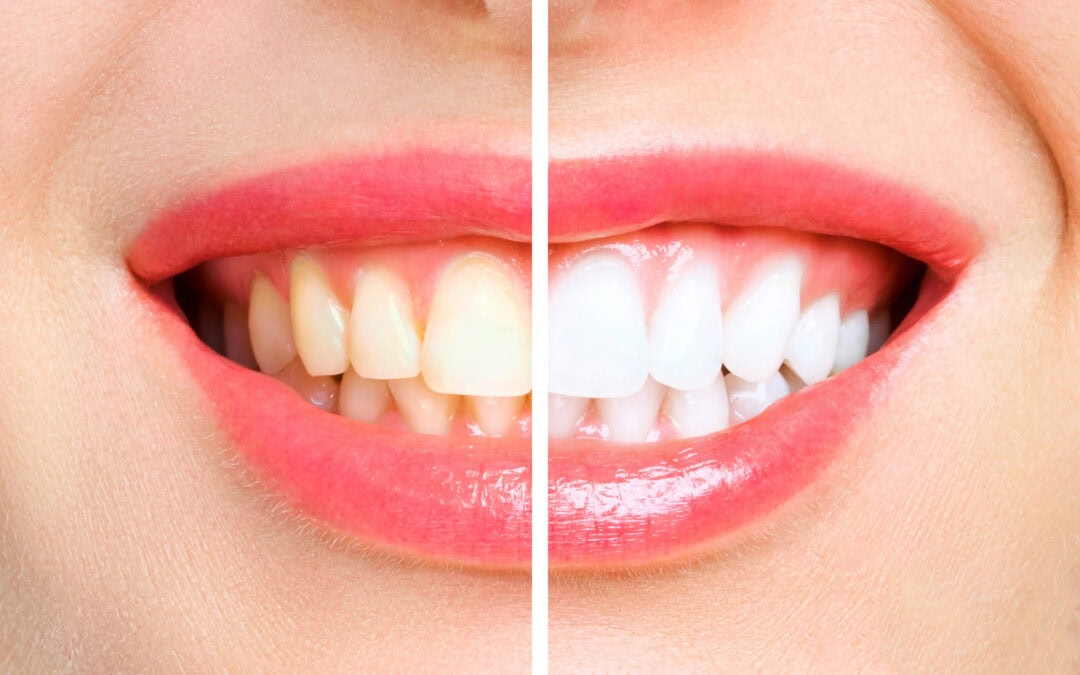 Before and after comparison of the effects of teeth whitening on a young woman's smile.