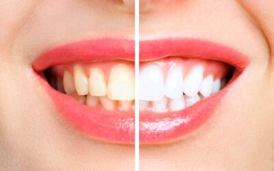 Why Isn’t My Teeth Whitening Working? Common Mistakes Explained