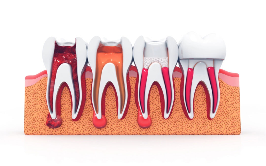 Illustration demonstrating the progression of a root canal infection and subsequent treatment
