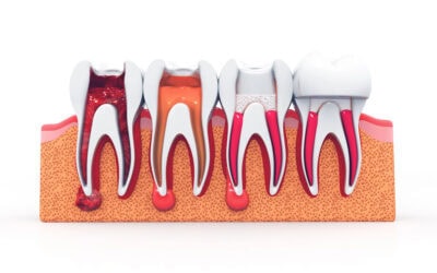 Do I Really Need a Root Canal? A Naperville Dentist Explains the Warning Signs You Shouldn’t Ignore