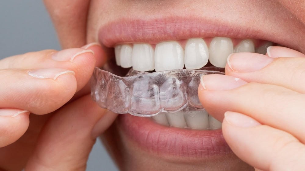 clear Invisalign braces liner being inserted on teeth