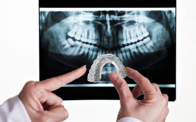 The Hidden Damage Caused by Nighttime Teeth Grinding