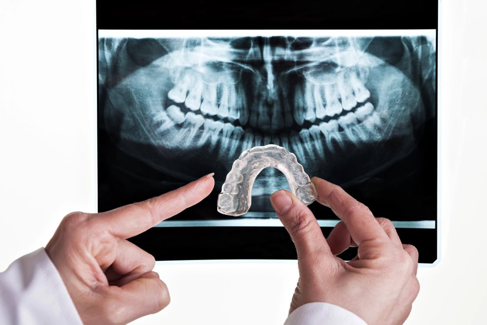 x-ray bruxism night guard illustrates TMJ treatment
