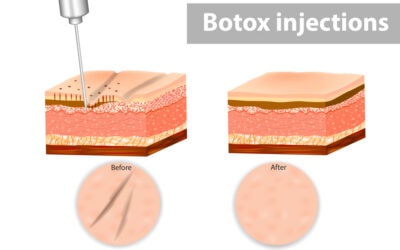 Why More Adults Are Choosing Botox® at Their Dentist