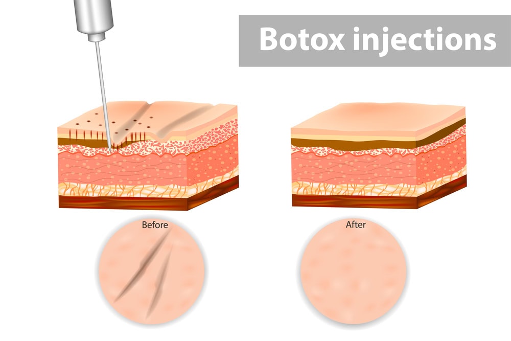 illustration of Botox injection results on facial skin