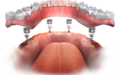 Why More Adults Are Choosing Dental Implants Instead of Dentures