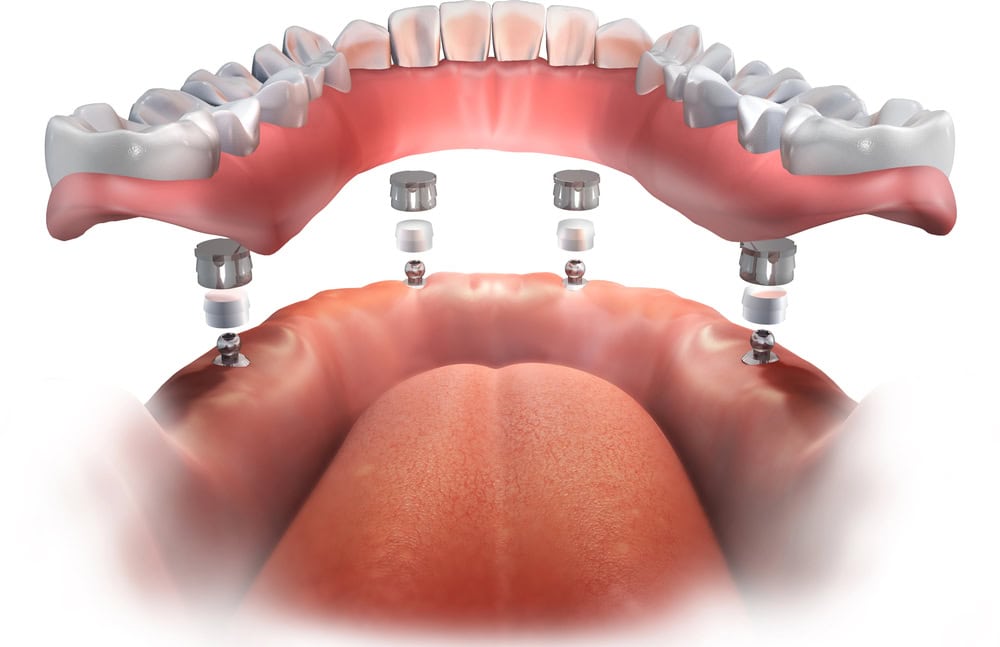implant dentures attached to dental implants
