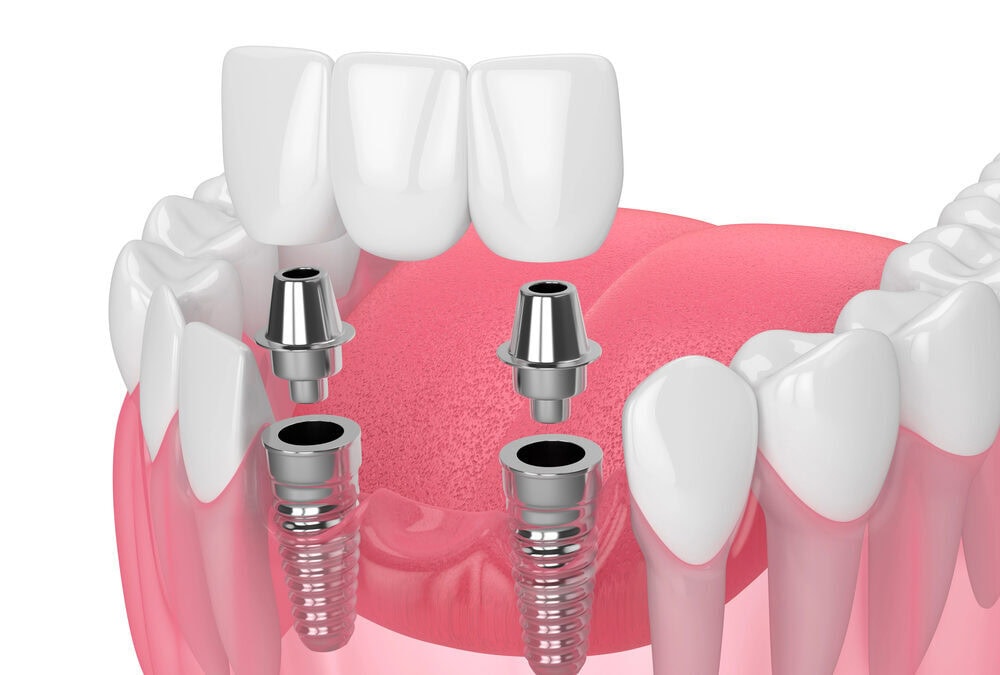 implant retained dental bridge placement on lower jaw