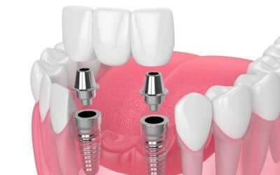 Dental Implants vs. Bridges: Which Tooth Replacement Option Is Right for You?