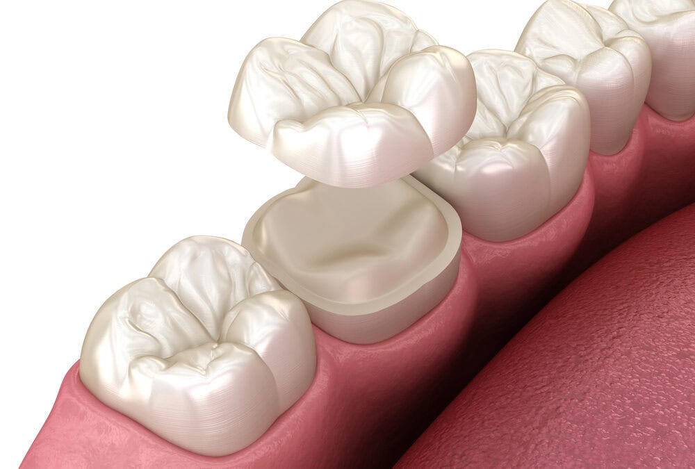 white dental crown on molar being placed