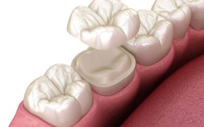 Do You Need a Crown or a Filling? Understanding the Difference